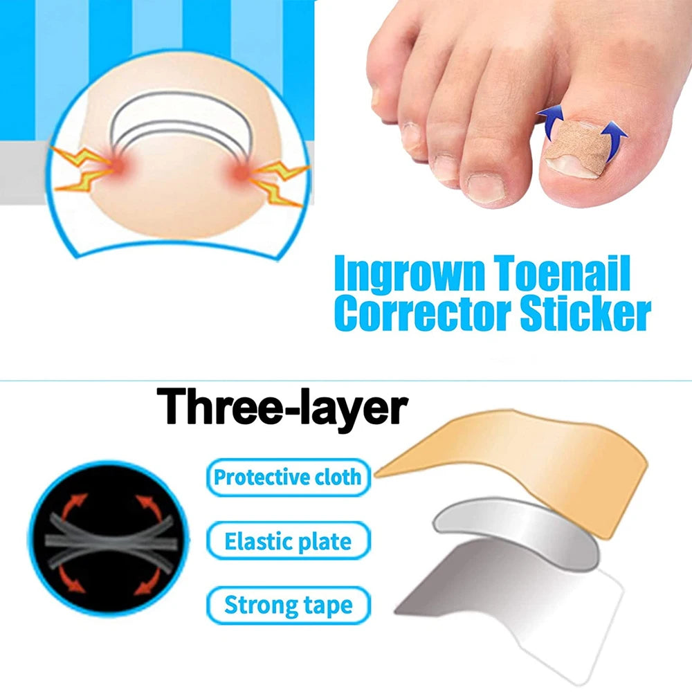 Ingrown Toenail Correction Set - Treatment Tools