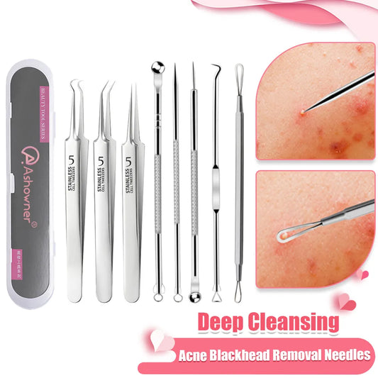 deep blackhead removal, blackhead removal, blackhead treatment, pimple removal, black head removal, black head remover, blackhead removal products, whiteheads removal