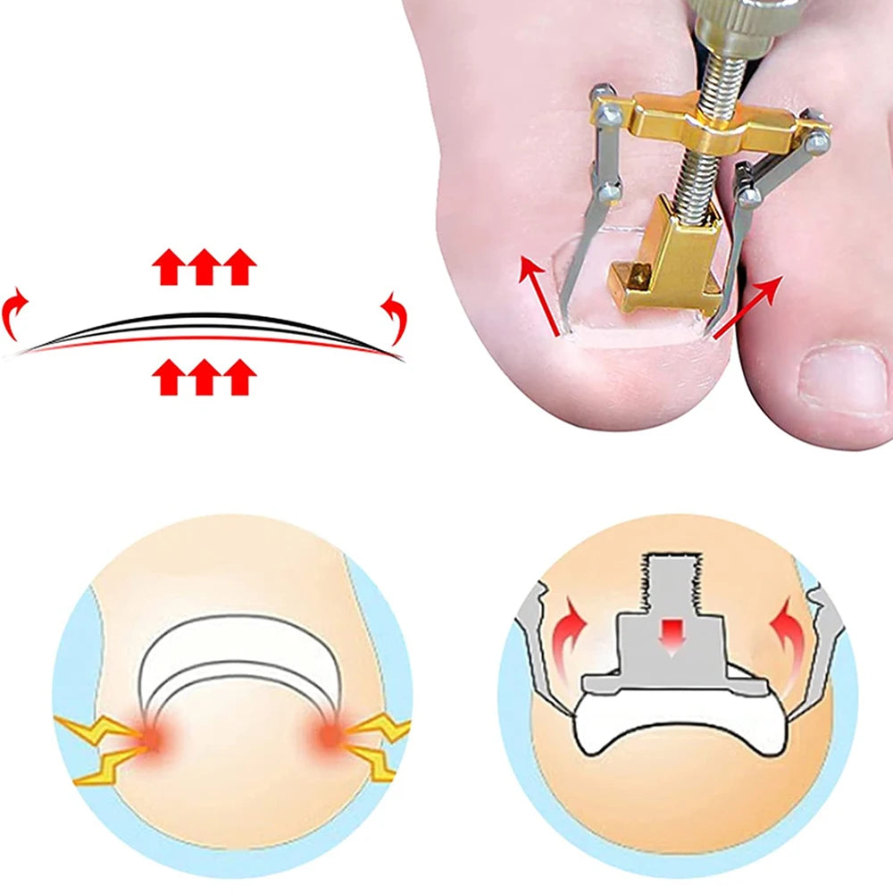 Kit de correction des ongles incarnés - Outils de traitement